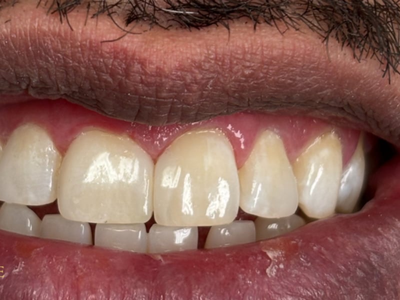 Front teeth with a gap after treatment