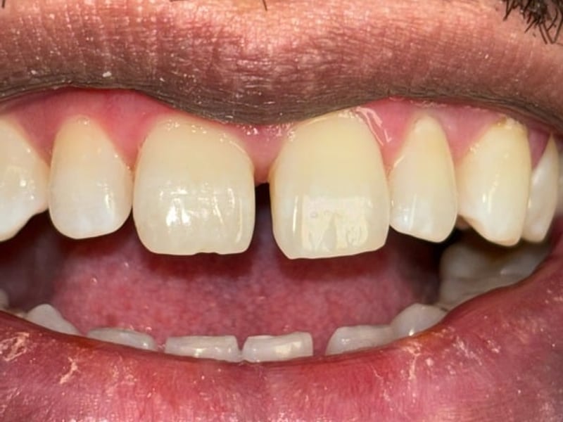 Front teeth with a gap before treatment