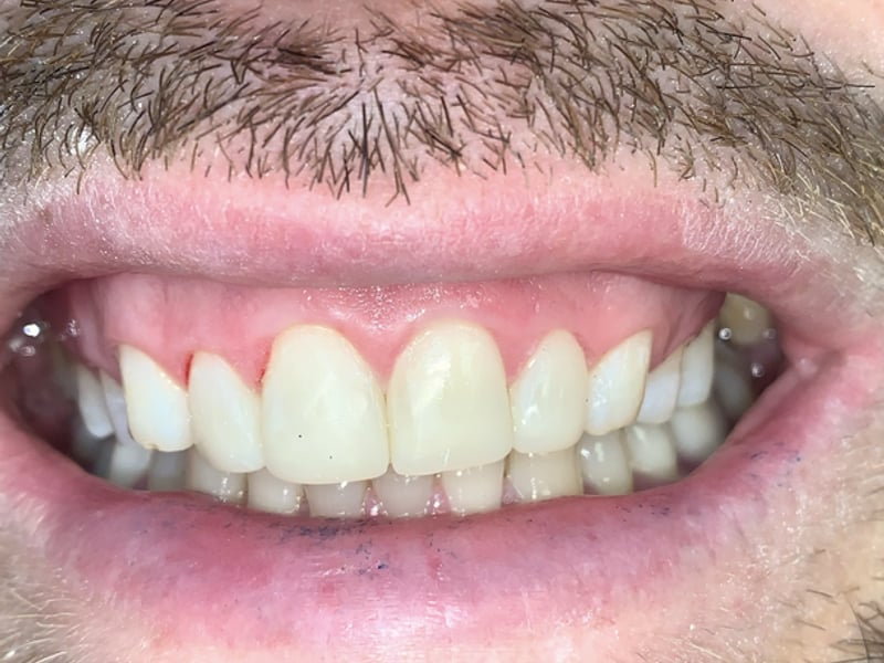 Worn front teeth after treatment