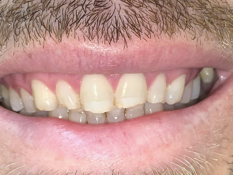 Worn front teeth before treatment