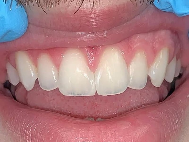 Uneven front teeth after treatment