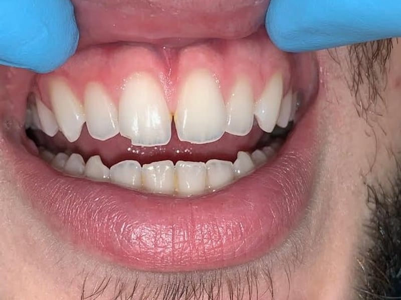 Uneven front teeth before treatment