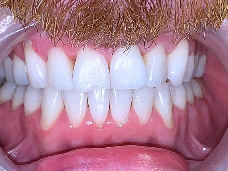 Crowded teeth after treatment