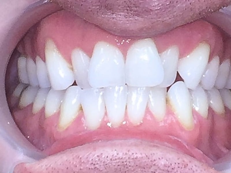 Crowded teeth before treatment
